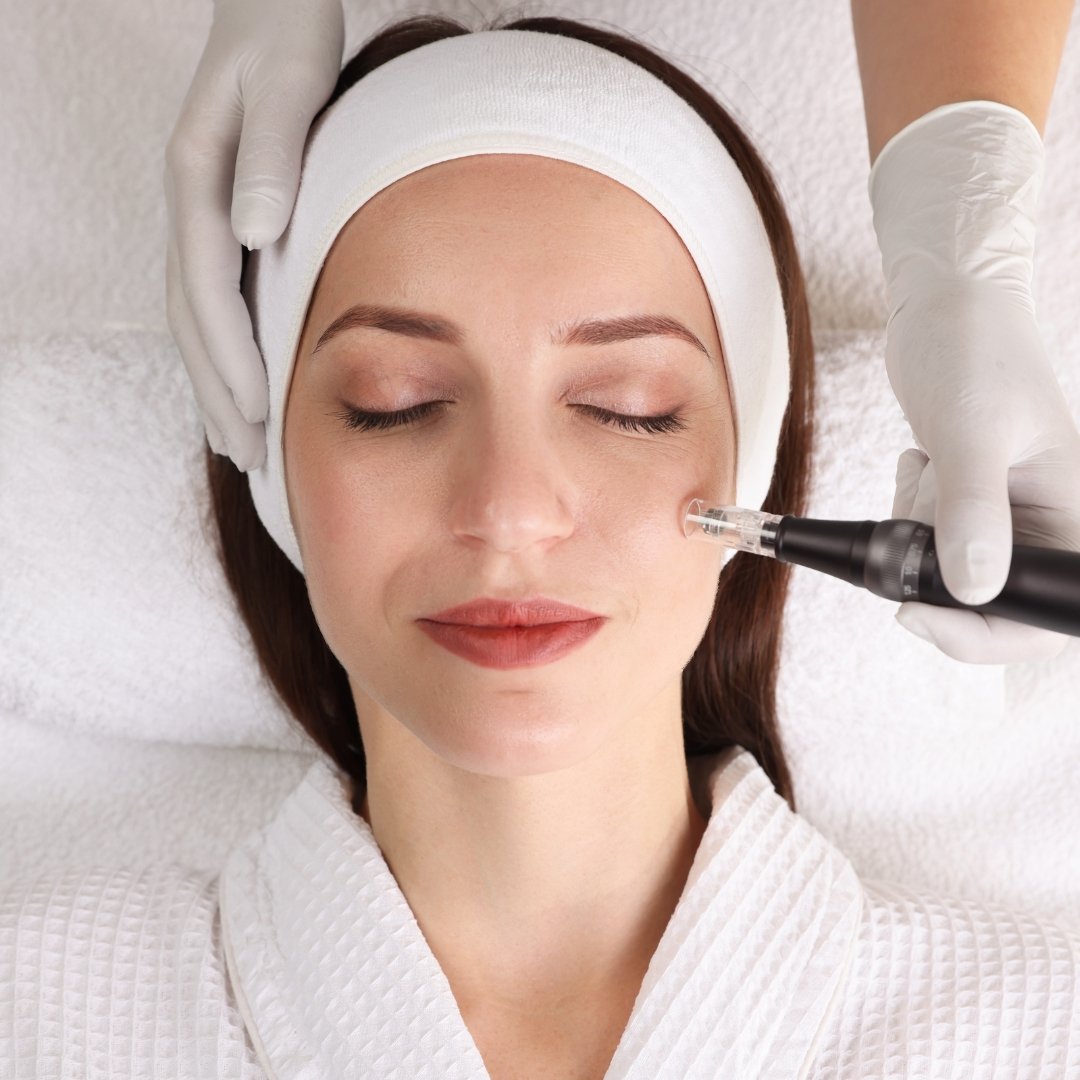 Microneedling in London