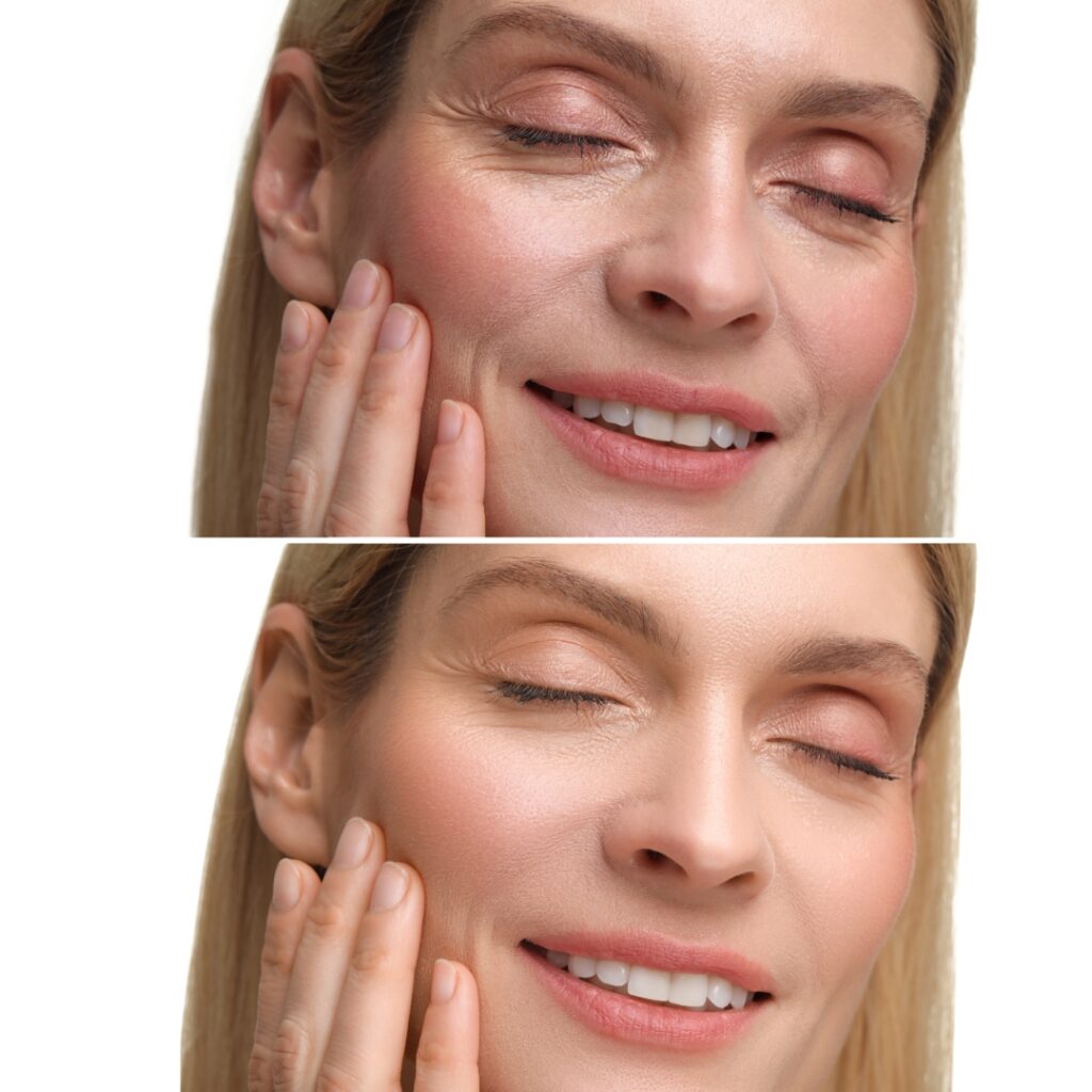 Profhilo Course in London