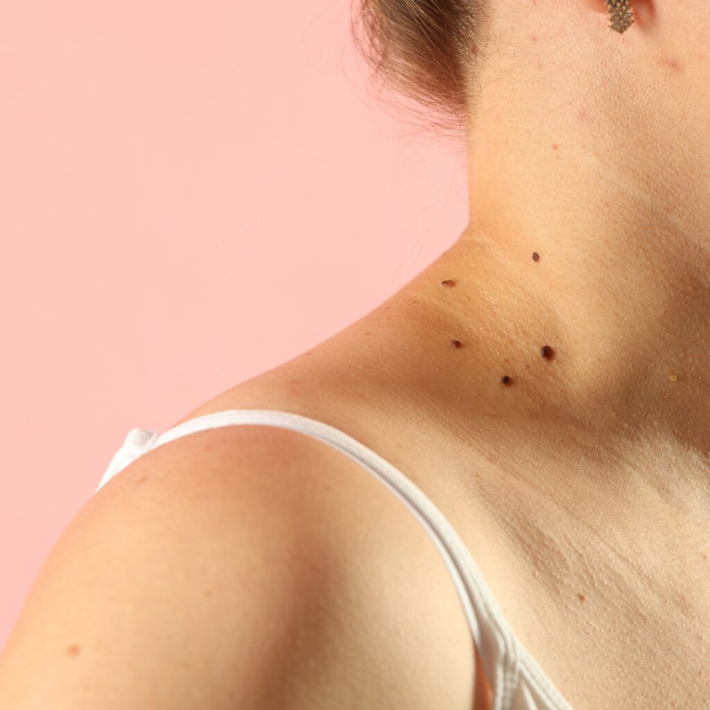 SkinTag Removal Course in London